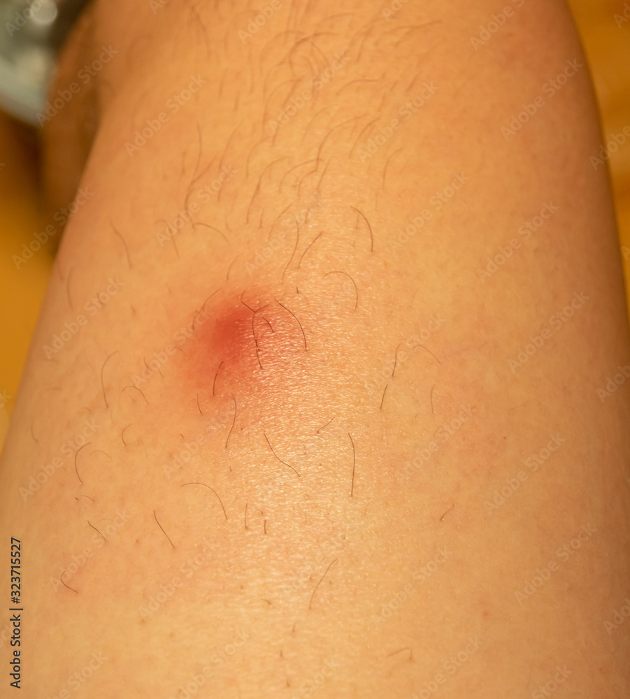 Fototapeta premium abscess on leg