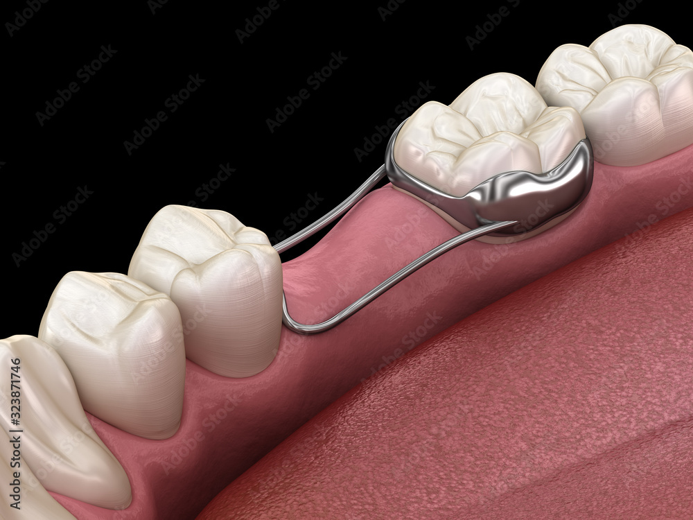 Space Maintainer Unilateral keeps from teeth shift deformatiuon after