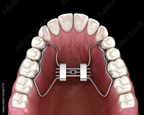 Rapid Palatal Expansion. Medically accurate tooth 3D illustration photo