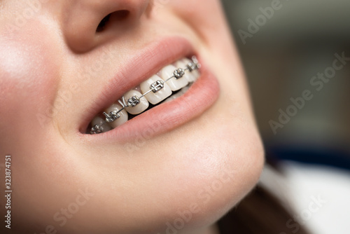 Orthodontic Treatment. Dental Care Concept. Beautiful Woman Healthy Smile close up. Closeup Ceramic and Metal Brackets photo