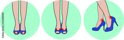 Illustration of possible spots of corns on the legs of a girl in high heel shoes