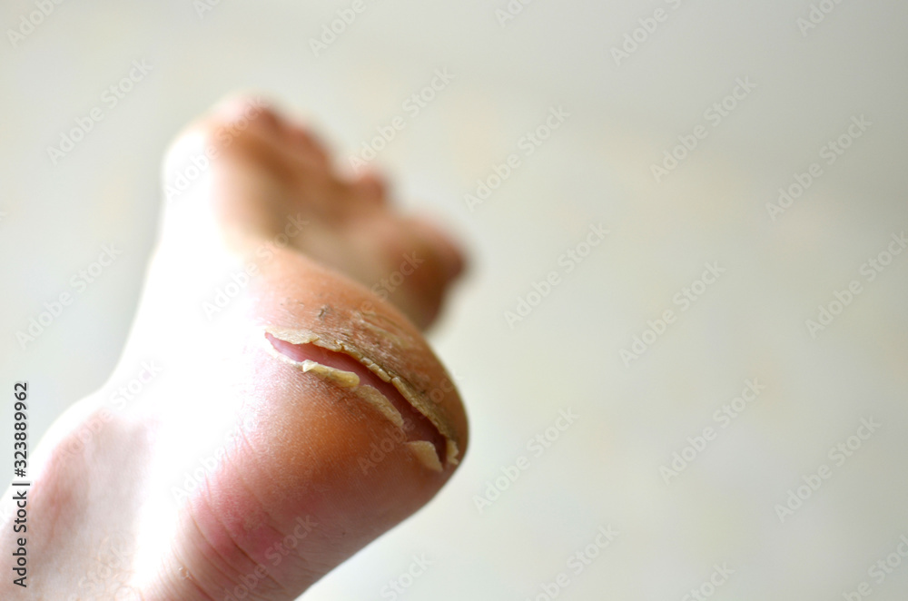 Dry cracked heel and callus on the foot. Monitor feet skin condition to