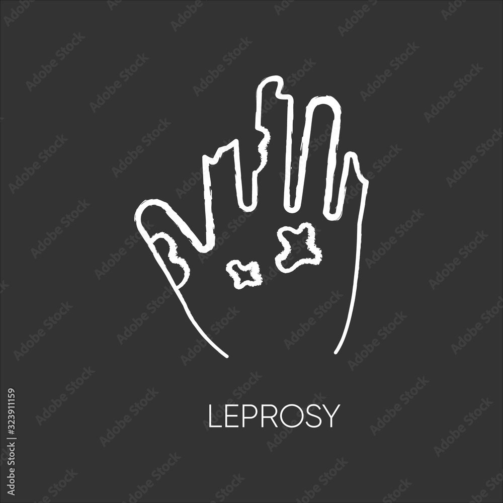 Fototapeta premium Leprosy chalk white icon on black background. Dangerous bacterial disease, contagious illness. Nerve damaging sickness. Disfigured human hand isolated vector chalkboard illustration