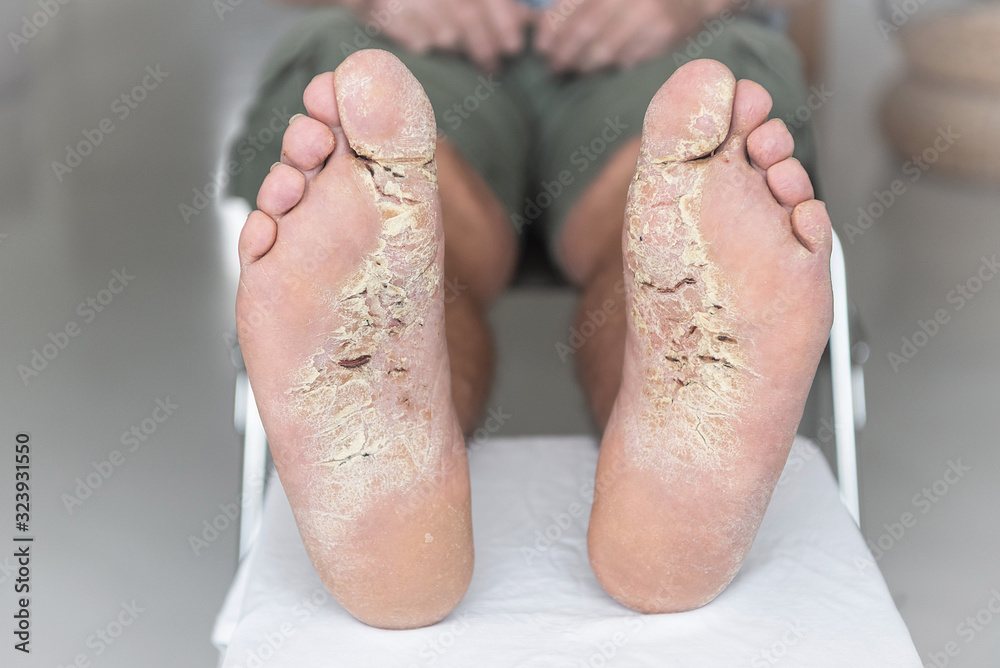 Hautkrankheit, Atiopischer Winterfuß, Fußekzem, Hautekzem, Dermatitis plantaris sicca