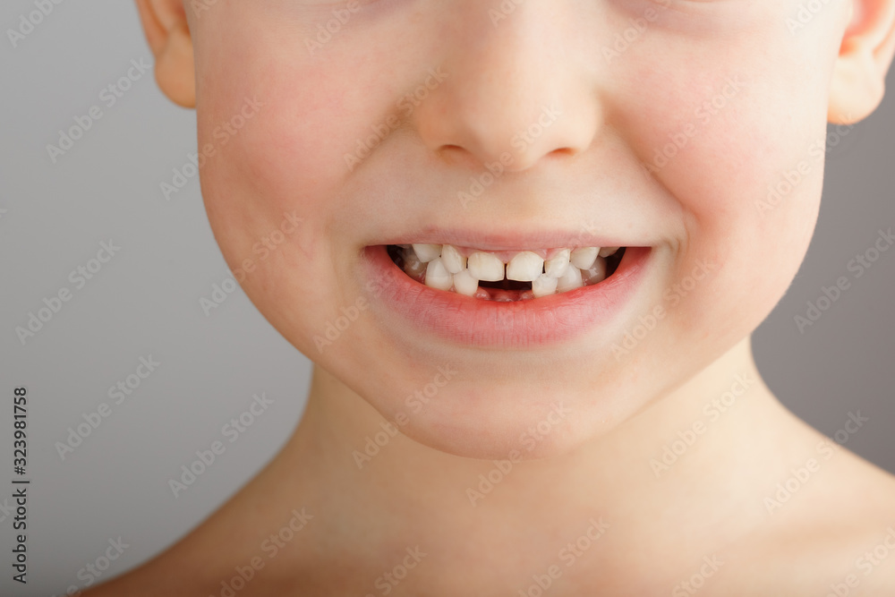 Obraz premium A child's smile without lower baby teeth. A hole in a child's smile. Fun concept.