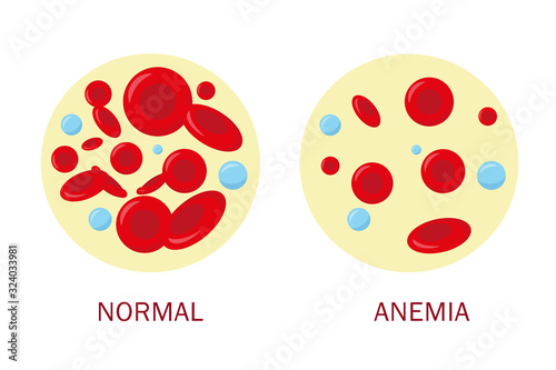 Nolmal blood cell and anemia blood cell. photo