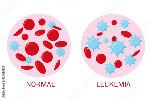 Normal blood and leukemia blood