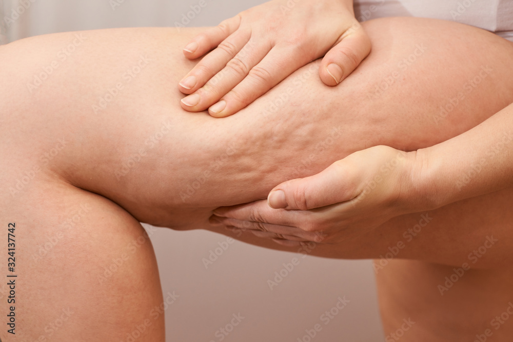 Cellulite leg woman pinch. Test fat hips treatment. Over weight liposuction.