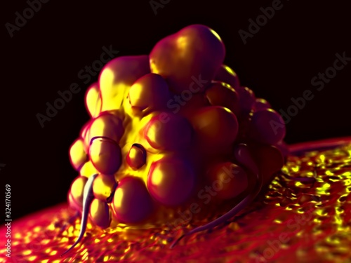 3d illustration - Brain Cancer Cells photo