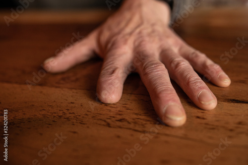 Tableau sur toile The amputated hand of a carpenter