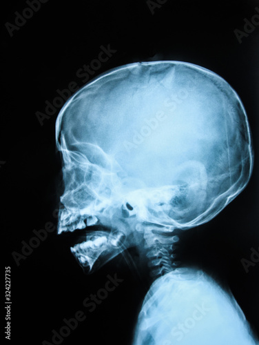 Film x-ray skul