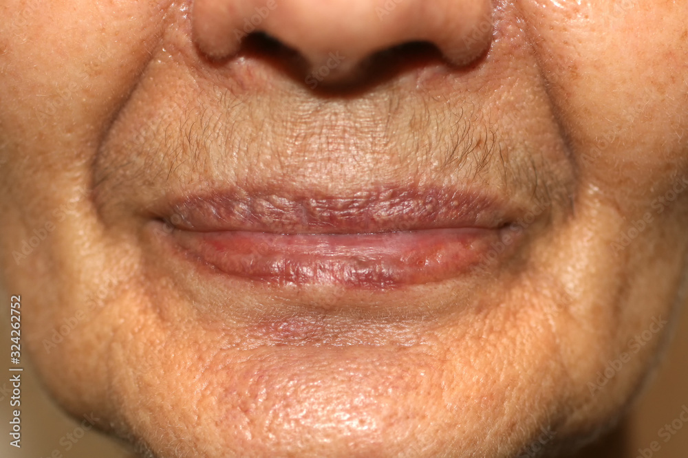 Nasolabial wrinkles. Wrinkles on the skin of the face of the neck. Flabby cheeks and neck Nasolabial wrinkles. Wrinkles on the skin of the face of the neck. Flabby cheeks and neck