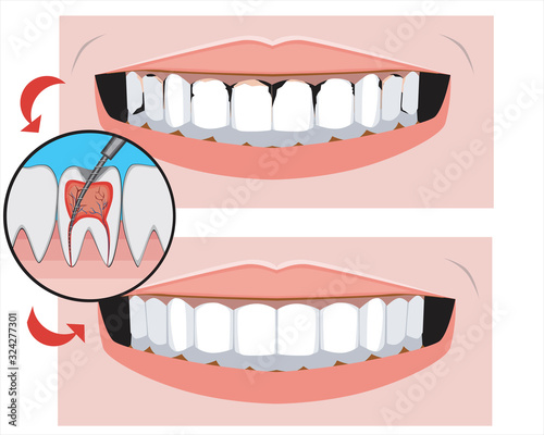 A smile with caries before and after the dental clinic, a vector stock illustration with molars as a concept for the treatment of pulpitis or nerve removal for design