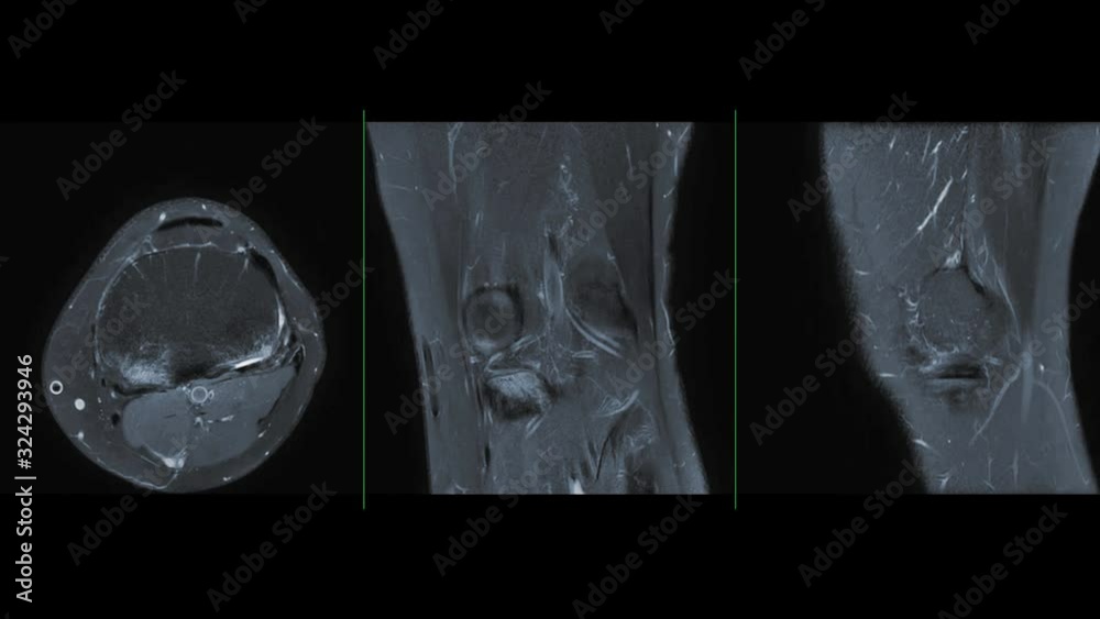 Compare of MRI knee or Magnetic resonance imaging of knee joint stir ...