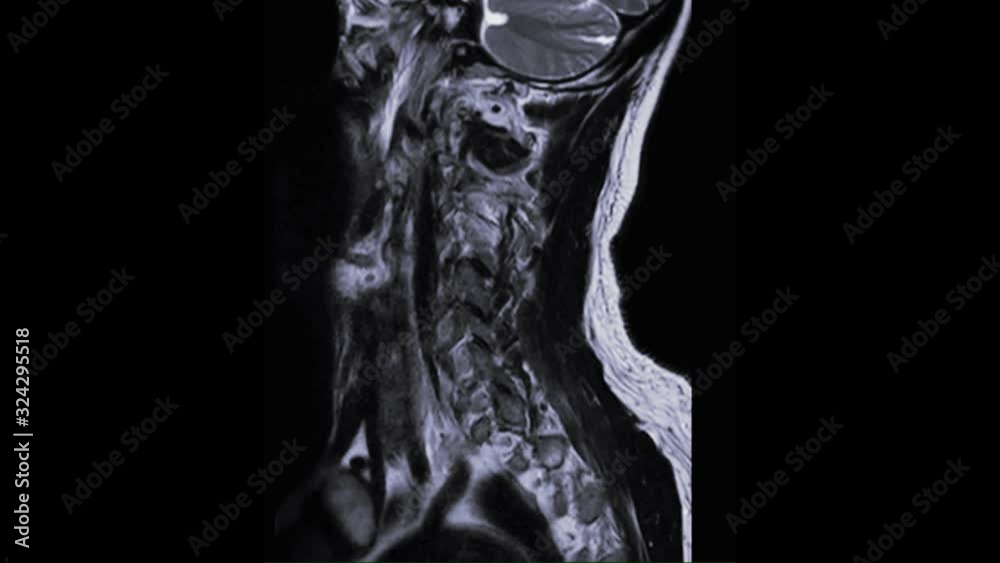 MRI of cervical spine sagittal T2W view for diagnostic Spinal Cord