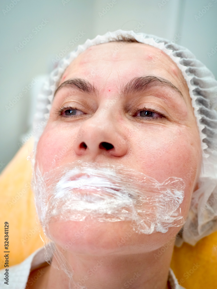 Applied application of analgesic on the lips of the patient before lips enhancement. Close-up. Applied application of analgesic on the lips of the patient before lips enhancement. Close-up.