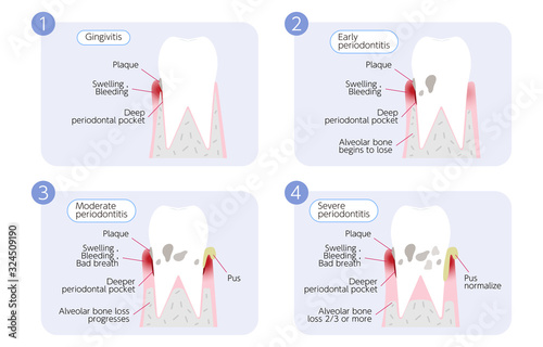 歯周病の進行イラスト、4段階