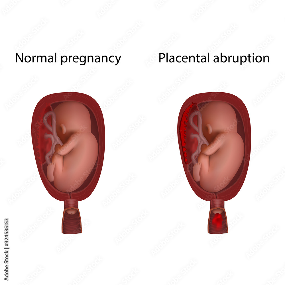 Placental abruption and normal. Fetus in uterus, womb, placenta
