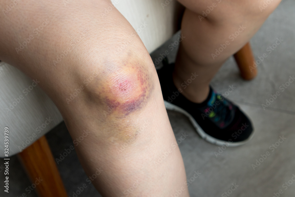 Naklejka premium Woman with Bruise
