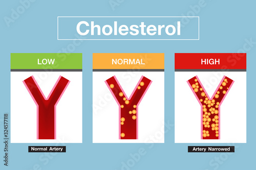 Cholesterol in artery, health risk , vector design