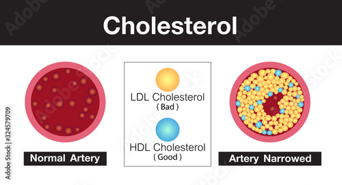 Cholesterol in artery, health risk , vector design