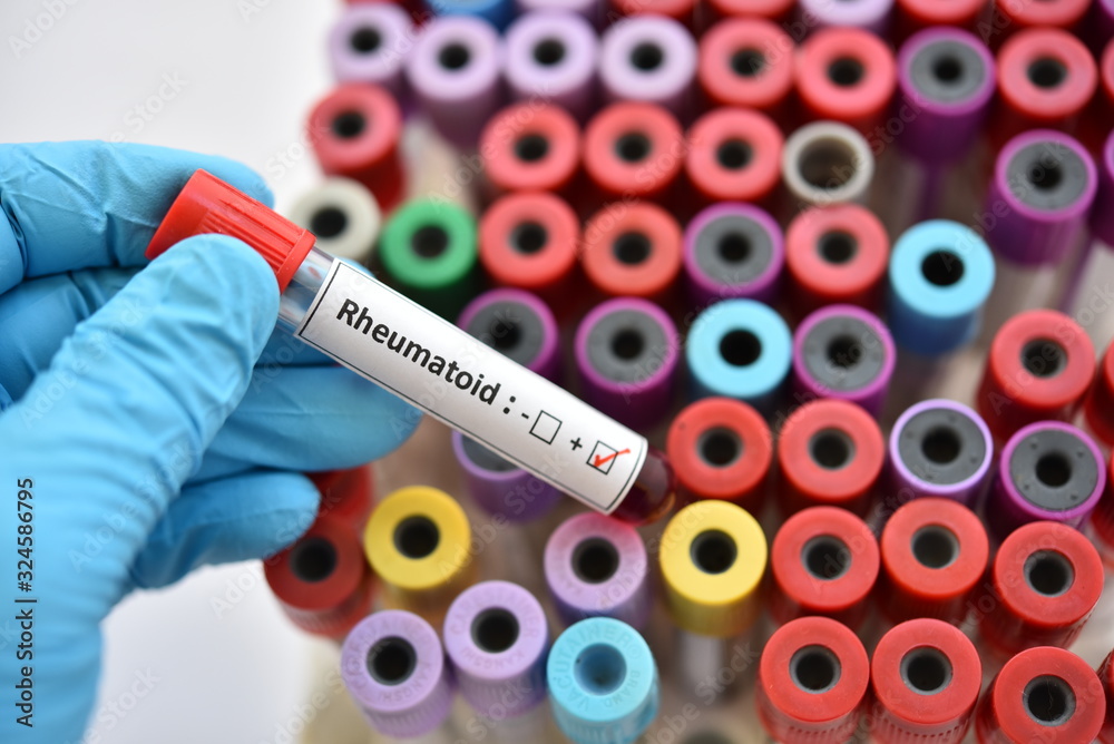 Obraz premium Blood sample tube positive with COVID-19 or novel coronavirus 2019 found in Wuhan, China