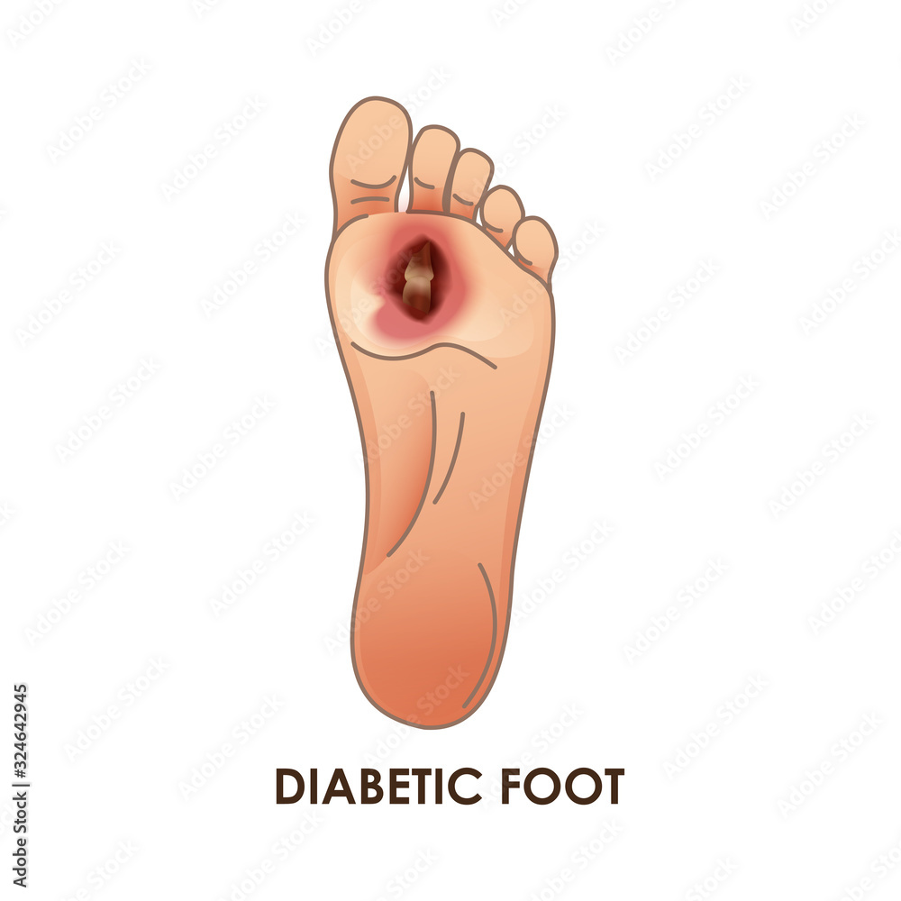 Diabetes Foot Ulcer: Symptoms, Prevention and Treatment