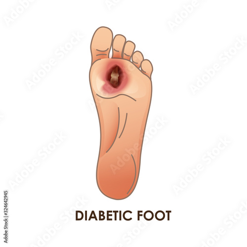 Diabetic Foot. Defeat, ulcer, skin sores on foot