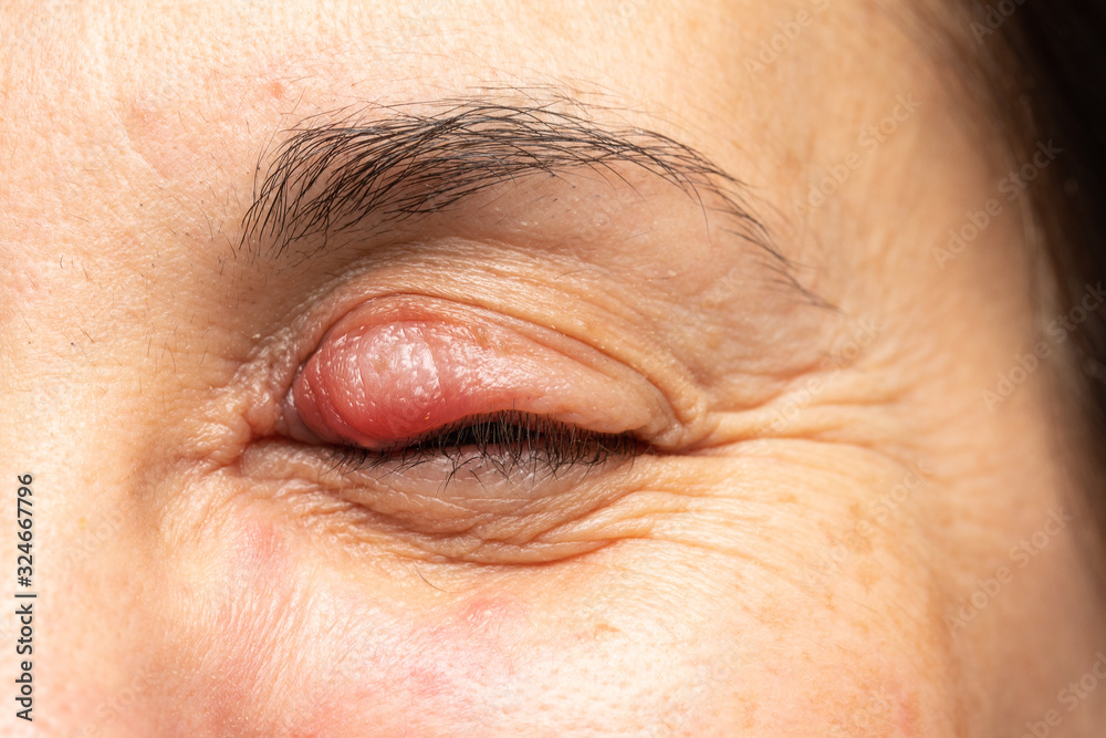 Swollen chalazion on the upper eyelid of a woman's eye, noticeable