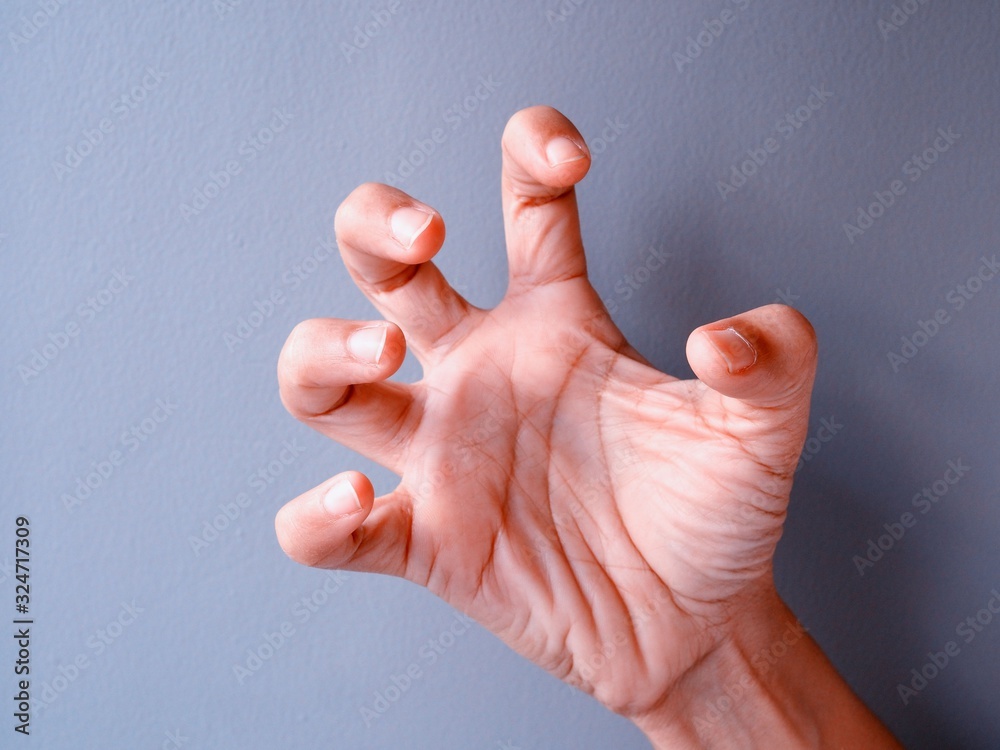 Hand of asian woman with spasms hand and twitches posture, hand tense. Stock Photo Adobe Stock