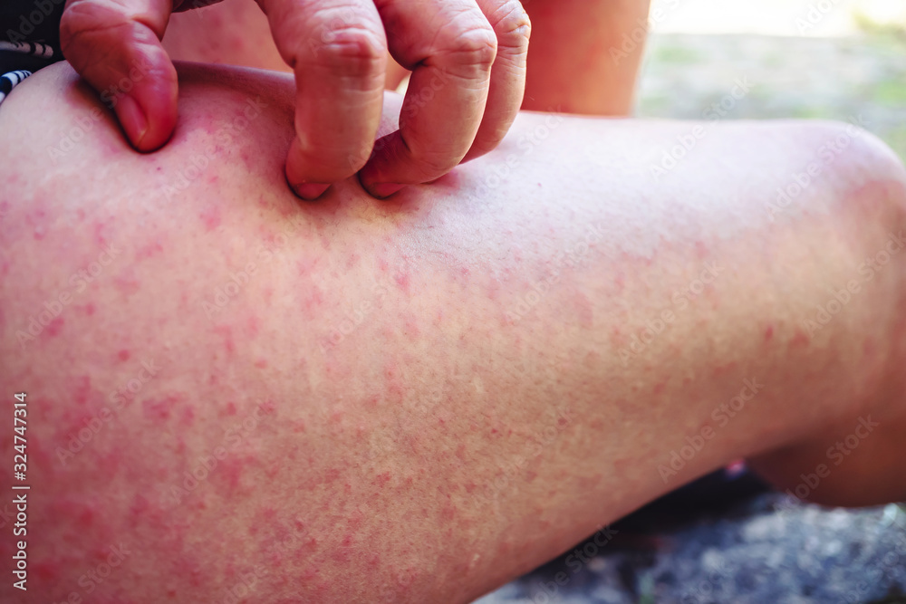 Itching of the wound on the thigh, A young woman scratching her legs with one hand due to itching, A woman scratching her thigh because of a rash. Itching of the wound on the thigh, A young woman scratching her legs with one hand due to itching, A woman scratching her thigh because of a rash.