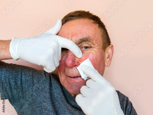 Demodecosis of the face. A man in gloves does the treatment of facial skin with medications. Prevention and treatment of skin diseases. photo