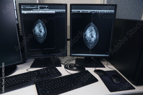 Mammography image on screens in a hospital laboratory
