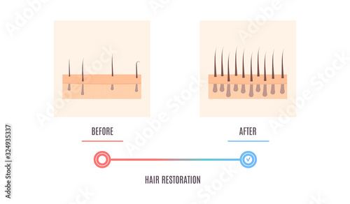 Scalp close up of hair follicles before and after alopecia treatment. Skin cross-section medical diagnostics diagram. Hair loss treatment and transplantation concept. Vector illustration.