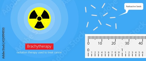 Brachytherapy procedure radioactive material medical treatment therapy