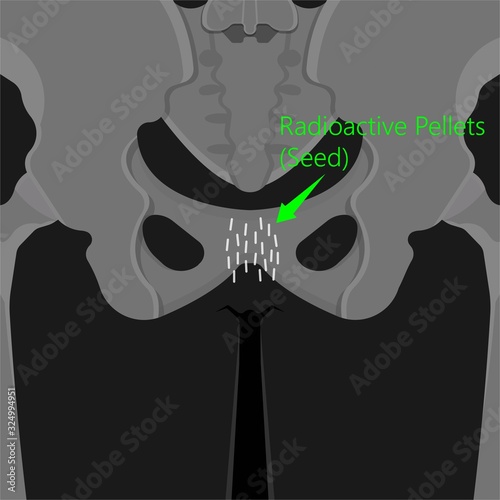 Brachytherapy procedure radioactive material medical treatment therapy