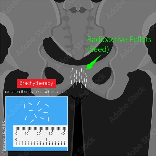 Brachytherapy procedure radioactive material medical treatment therapy