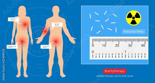 Brachytherapy procedure radioactive material medical treatment therapy