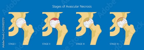 Avascular necrosis bone tissue disease