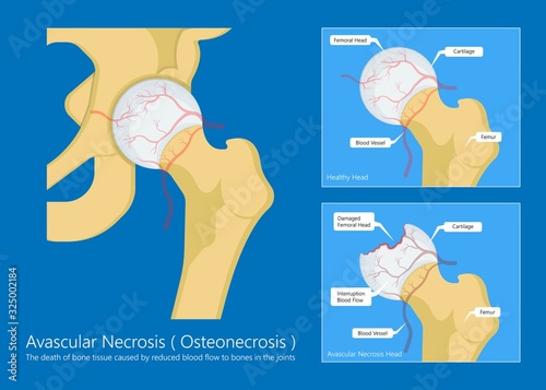 Avascular necrosis bone tissue disease photo