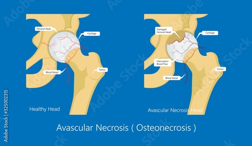 Avascular necrosis bone tissue disease