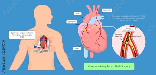 Heart disease treatment surgery patient
