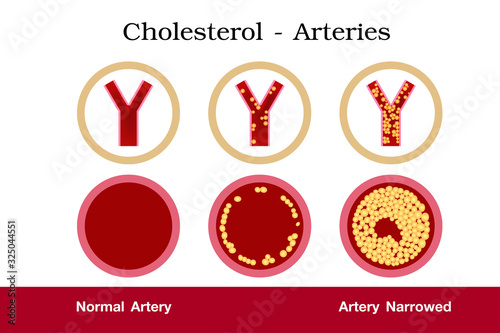 Cholesterol in artery, health risk , vector design