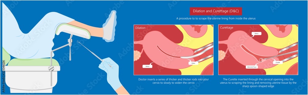 Vetor De Dilation And Curettage D C Diagnostic Treat Uterine Heavy Exam