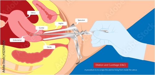 endometrial biopsy examination uterus procedure