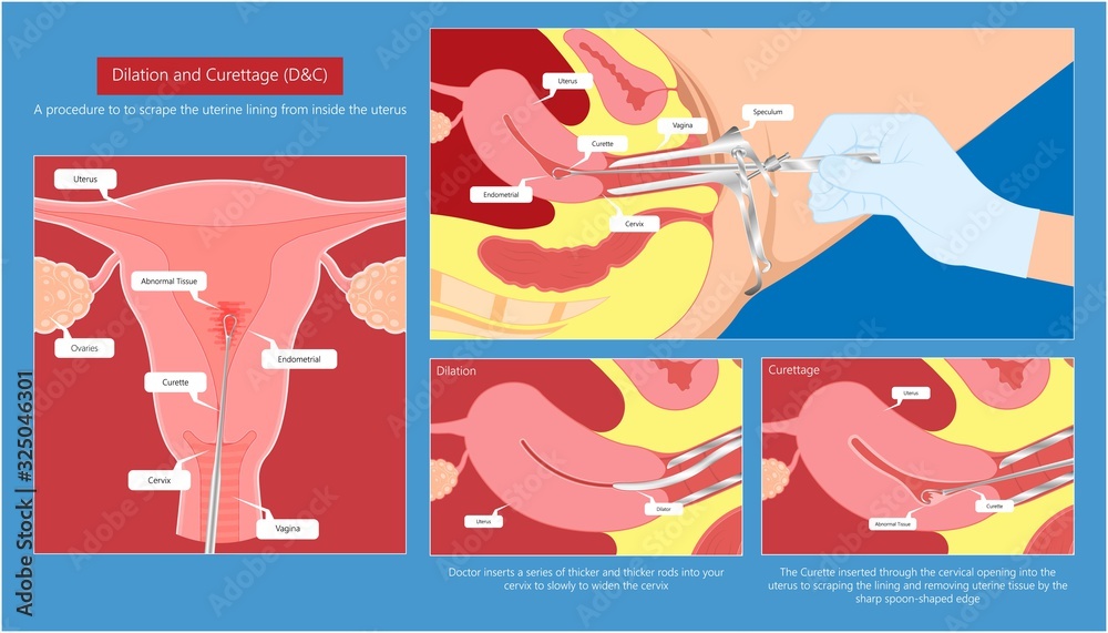 Dilation and curettage D&C diagnostic treat uterine heavy exam biopsy lab cancerous therapy