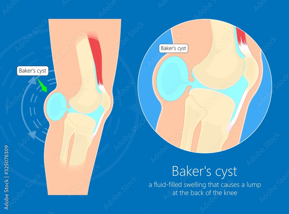Baker's cyst (Popliteal) swelling knee joint inflammation arthritis