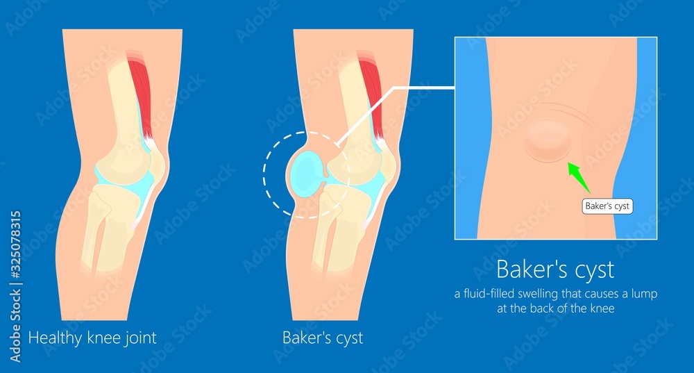 Baker's cyst (Popliteal) swelling knee joint inflammation arthritis