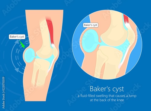 Baker's cyst (Popliteal) swelling knee joint  inflammation arthritis gout