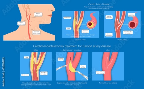 Coronary artery disease CAD diagnosis treatment
